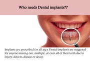 Dental Implants Malvern